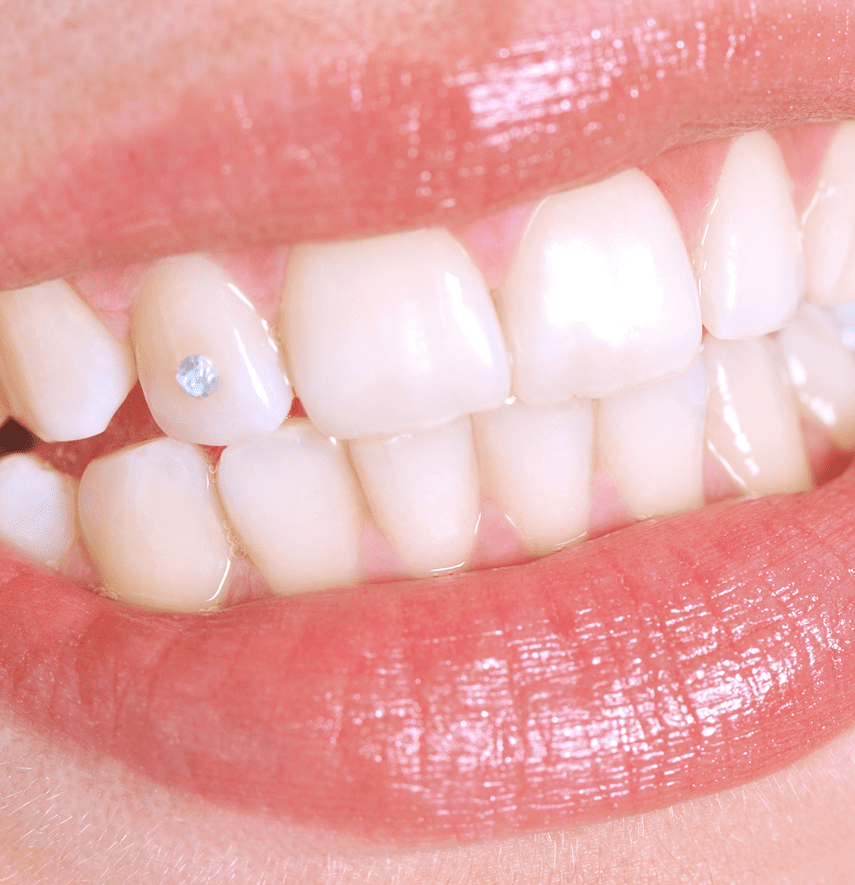 Shiny tooth gem on bright smile