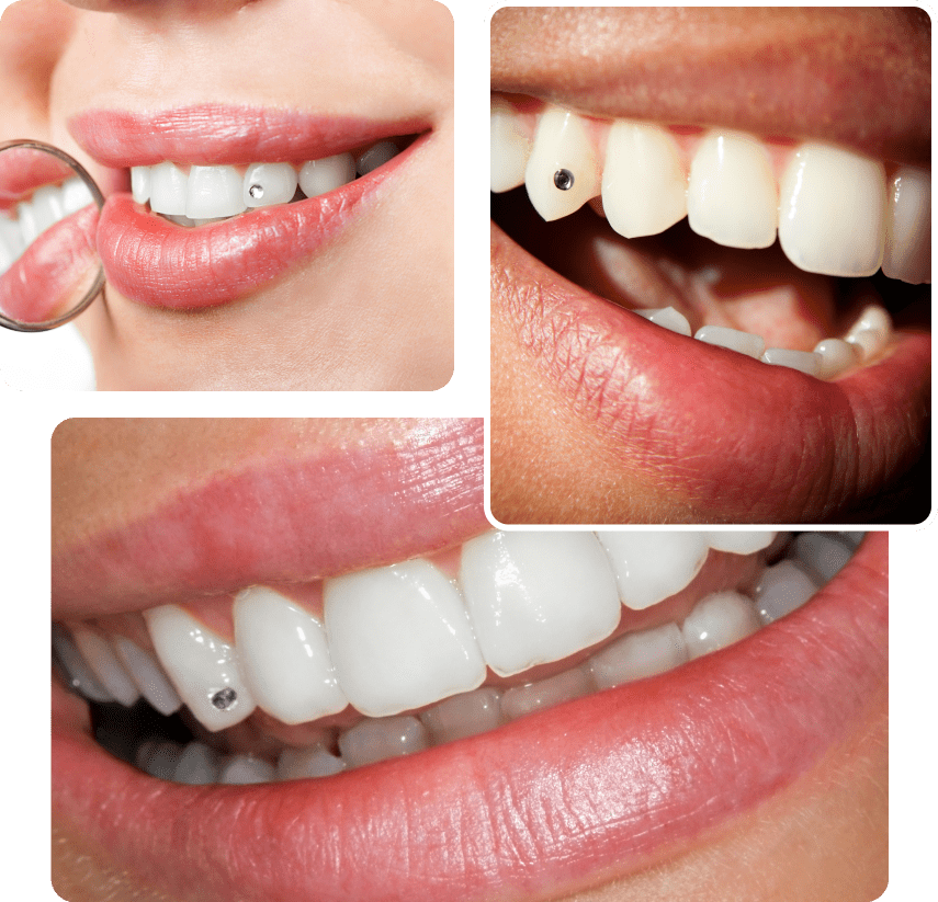 Teeth with small dental jewelry
